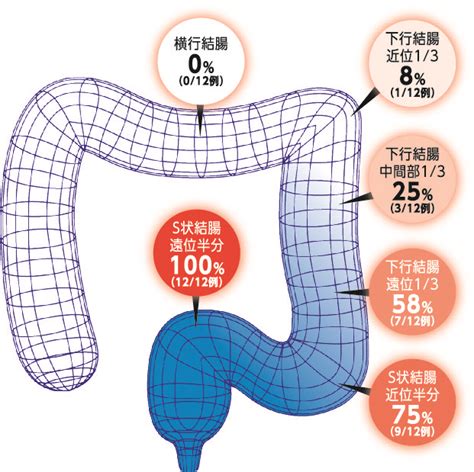 性転換大腸法|MtF / S字結腸 